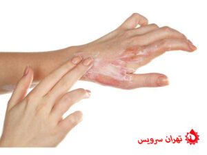 سوختگی ناشی از اسید لوله بازکن